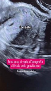 Tra la 6ª e la 10ª settimana, in poche settimane, il piccolo punto che si vede all’ecografia diventa un vero e proprio embrione in crescita. La camera gestazionale si allarga, compare il sacco vitellino, poi il polo embrionale… e finalmente il battito 💓 Ogni immagine racconta un momento diverso di questo straordinario inizio. E ogni settimana ha il suo ritmo, i suoi tempi, la sua magia — anche quando l’attesa sembra infinita. Se vuoi sapere cosa aspettarti alla prima ecografia, come leggere i r