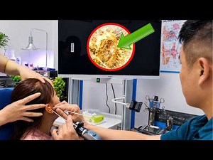 子どもの耳掃除で大量の耳垢を除去｜スッキリ爽快ASMR EP.20
