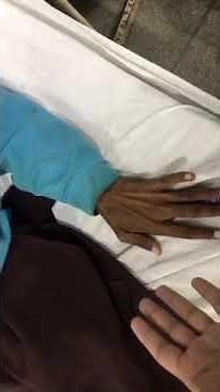 Milkmaid’s grip in Chorea