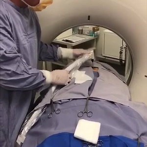 166K views · 530 reactions | CT guided Cryoablation with injection of immunotherapy, Yervoy, OX40 antibody, TLR Agonist in a patient with non small cell lung cancer. | Williams Cancer Institute | Facebook
