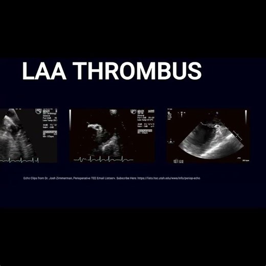 What Left Atrial Appendage Thrombus Looks Like on TEE: Real Cases
