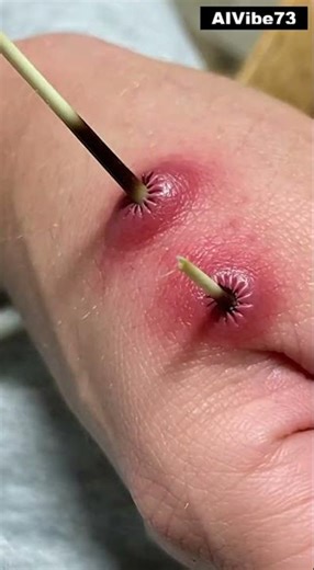 Why Porcupine Quills Are Worse Than Needles (Microscopic View)