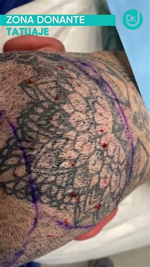 Zona donante tatuada en la cabeza. Caso especial. Injerto capilar Doctor Jofré