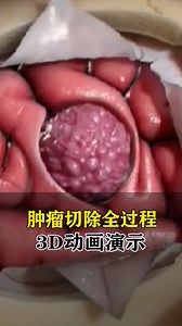 脑肿瘤切除全过程动画演示