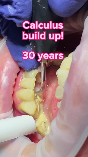 Calculus build up over 30 years! This patient had a bad dental experience as a child. We are glad they came to us and allowed us to examine their oral health and carry out the necessary procedures at our dental practice in Leeds. #leedsdentist #dentist #dentistry #calculus #plaque #hygienist #cleaning #teeth #dentaltok #leeds