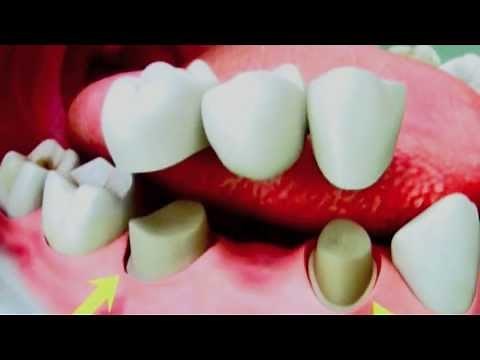 Dental Bridges - How to properly clean your teeth