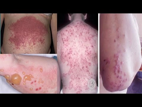 Bullous Diseases | Part 2 | Dermatology