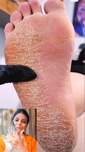 1.1M views · 5.4K reactions | Winter 略 Special Feet Care || Dry & Cracked Heels Home Remedies #shorts #skincare #viralreelsfbpage #fypシviralシ2024 #viralreelsシ #reelsfbシ #fbviralreels #viralreels #viralreelsfb #reelsfb #virals #reelsfypシ #fypviralシ #fypシ゚viral | Beauty With Sunanda | Facebook