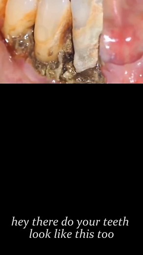 #dentistry #satisfying #dentalcalculus