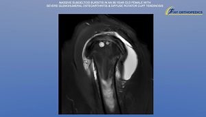 Massive Subdeltoid Bursitis in an 86 Year Old Female With Severe Glenohumeral Osteoarthritis & Diffuse Rotator Cuff Tendinosis