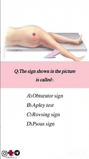 Psoas sign in appendicitis #medicalstudent #medicine #sign #appendix#appendicitis
