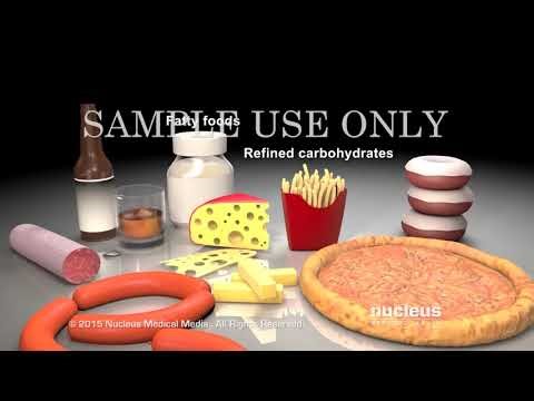 Strategies for Hyperlipidemia Management