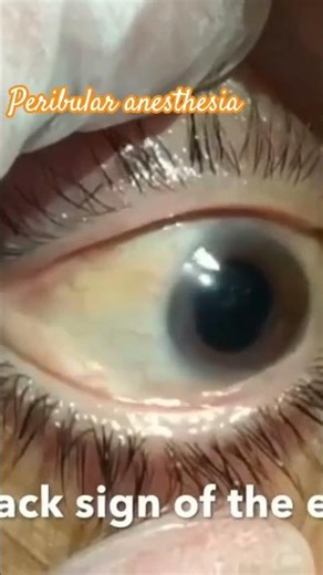 Peribulbar Anesthesia Explained – How Eye Surgery Becomes Painless 👁️