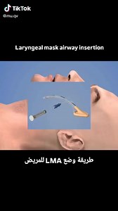 63K views · 933 reactions | LMA (Laryngeal Mask Airway) - ماسك...