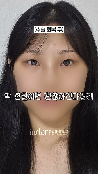 눈 잘 뜨려고 눈매교정했는데 안 감겼던 썰 #성형정보 #눈매교정 #눈성형 #성형외과 #인스타성형외과 #무쌍눈매교정 #무쌍눈매교정부작용 #눈매교정부작용 #눈성형부작용 #성형후기