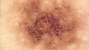 FotoFinder invented the ATBM procedure. Based on the “two-step method of digital follow-up”, it helps physicians to detect new and changed skin lesions as early as possible – a quantum leap in skin cancer diagnostics. Today, FotoFinder goes one step further and revolutionizes Automated Total Body Mapping: the new ATBM master makes Total Body Dermoscopy possible for the first time. The combination of the “whole skin” imaging procedure with artificial intelligence and novel software functions for 