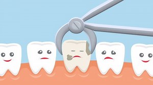 Cartoon Tooth Extraction Dental Animation Reception Stock Footage Video (100% Royalty-free) 1017511459 | Shutterstock