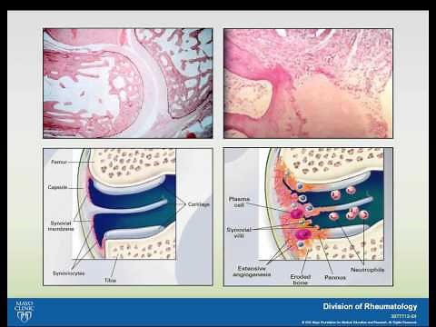 Rheumatoid Arthritis and Systemic Lupus Erythematosus Webinar