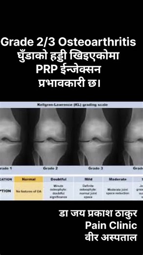 #kneepain #prptreatment #ultrasoundguidedinjection #kneeosteoarthritis #chronicpain #दीर्घकालिनदुखाईopd #drjayprakashthakur #prpinjection #fy #fyp #fypage