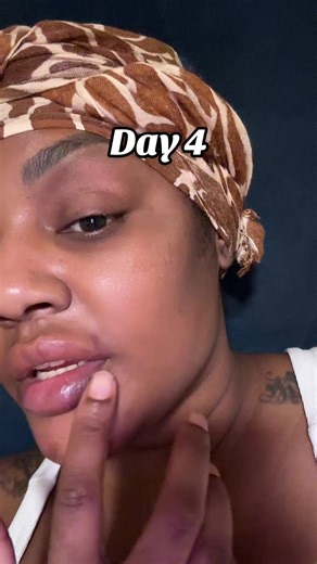 I skipped a couple days because life healing me looking a little crazy 😅 I don’t think I’m doing the full 2 weeks of updates. I’ll pop back in at 2 weeks so yall can see how it all comes together 😅 This was in my drafts from 2 days ago #fyp #blacktiktok #botox #transformation
