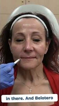 Master Nasolabial Fold Treatments with Xeomin & Belotero | Pro Filler Training for Injectors Part 2