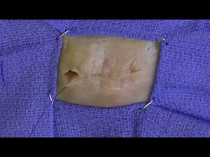 Intradermal Suture Pattern