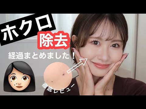 【美容医療】ホクロ除去の経過や傷跡、再発などビフォーアフターお見せします！【みーきです。】