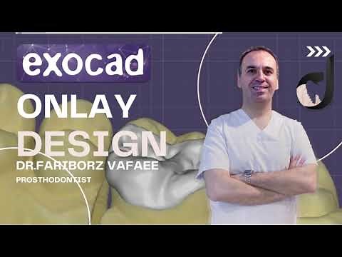 How to design a perfect inlay /onlay in exocad 3.0 galway