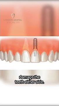 Surgical Tooth Extraction What to Expect from Start to Finish #shorts