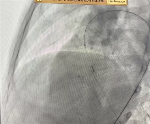Perimembranous VSD device closure using ADOII Device (retrograde approach)I used Glidewire and JR catheter to cross the defect | Dr Ali Al-Talhi