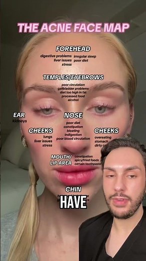 Acne Facial Skin Mapping | What Does Your Pimples Mean? | MaximumSkin