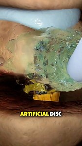 How Cervical Disc Replacement Surgery is Done? (3D Animation) #how #cervical #discReplacement #surgery #surgeon #doctor #pain #muscle #neck #weakness #medical3danimation #3dmedicalanimation | Medcare777