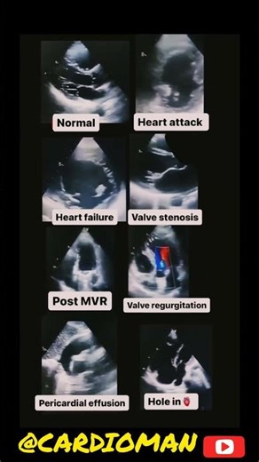 NORMAL Vs ABNORMAL #echocardiography