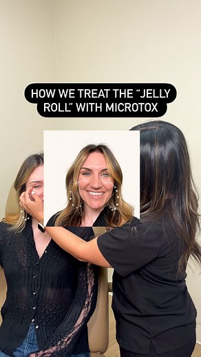 NEEKAN RIVERA | Expert Injector+AllerganTrainer on Instagram: "How To Injection Tips: Botox for the under-eye ‘jelly roll’ 👁️ Listen to how I address if a patient is a good candidate to have their pre-tarsal bulge, also known as the ‘jelly roll’, treated with Botox. As we celebrate the launch of Aère Academy, we will be spotlighting different treatments with injections tips. Comment below with more treatment tips you want to learn about 👇🏽 . . . #LAMedSpa #denvermedspa #BeautyTrends #NaturalB
