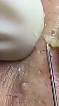 Pimple Remove Facial | Acne Clean Skin Care