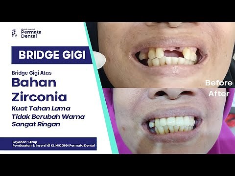 Proses Pembuatan & Pemasangan Gigi Depan Bridge Berbahan Zirconia di Permata Dental