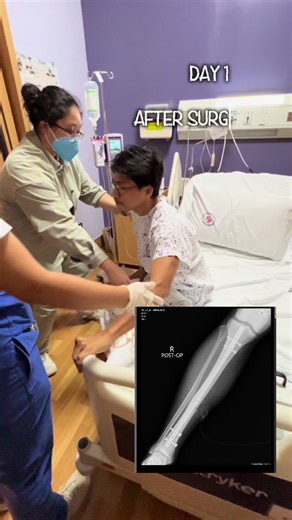 Tibia Fracture Recovery Journey: Day 1 to Day 37