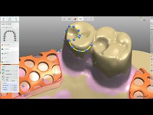 3shape upper partial