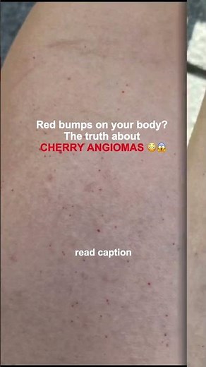 Red bumps on your body? The truth about CHERRY ANGIOMAS 😳