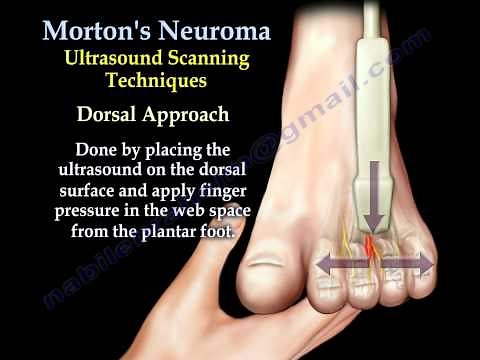 Morton's Neuroma - Everything You Need To Know - Dr. Nabil Ebraheim