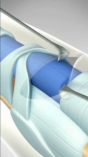 Do you know what a Jersey Finger is? Flexor Tendon Injury and Surgery #brokenfinger #fingerfracture