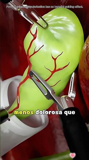 How Laparoscopic Cholecystectomy Is Performed (3D Animation)#medical3danimation #3dmedicalanimation