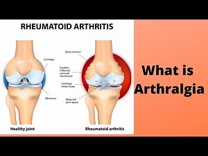 What is Arthralgia