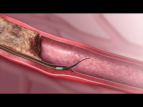 BeBack - Re-entry device