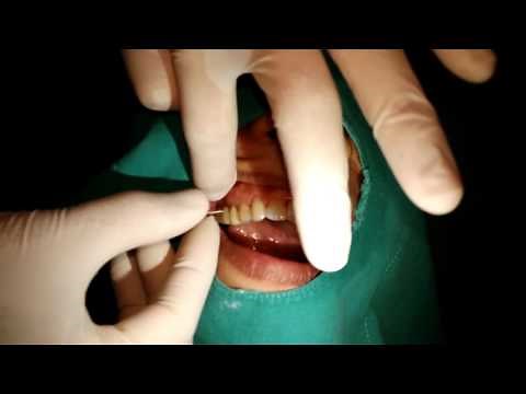 How to use the superfloss between dental bridge
