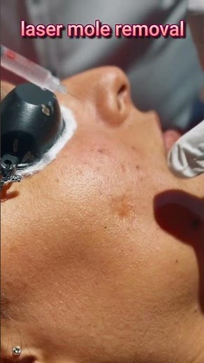 Advanced laser Mole Removal Technique | Scarless Mole Removal 1