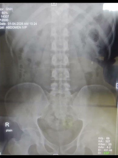 intra venous Pyelography