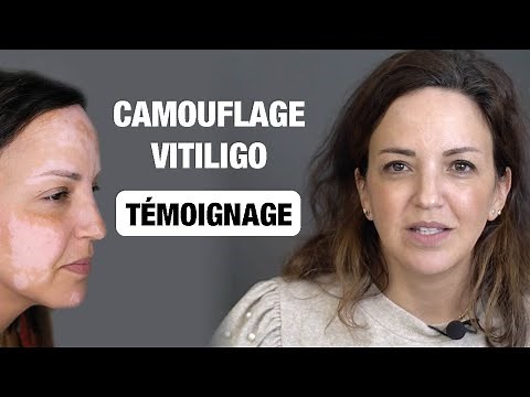 Comment camoufler le Vitiligo grâce à la Dermopigmentation par Carole Evrard, Championne du Monde?