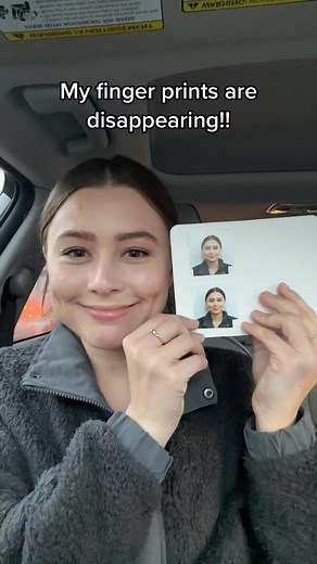 Understanding Fingerprint Loss for Occupational Therapy