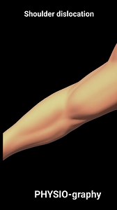 Shoulder dislocation | PHYSIO-graphy